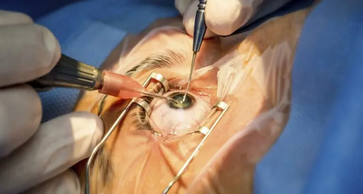 Cirurgia de catarata com tecnologia avançada na Clínica Provida